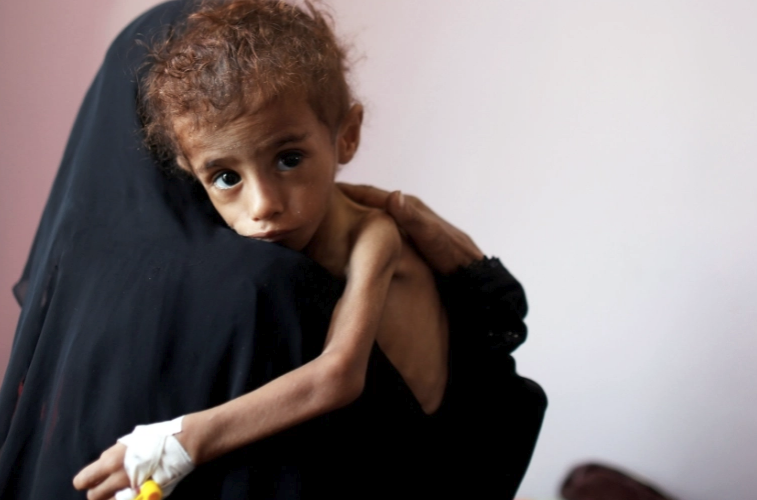 Yemen'de insanlar ölmekle kalmıyor, ölüme terk ediliyor