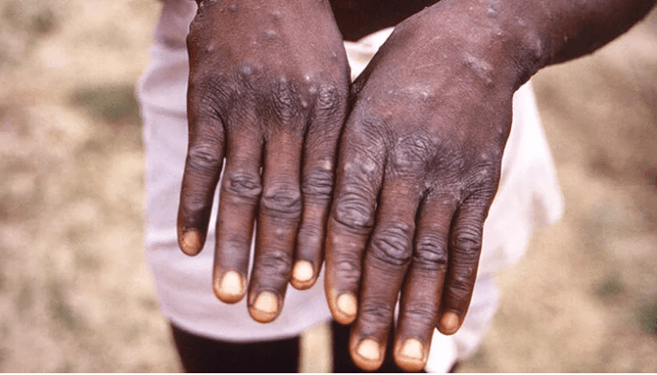 Everything you need to know about monkeypox