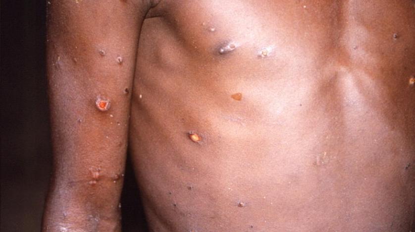 The WHO announced that 80 cases of monkeypox have been recorded worldwide
