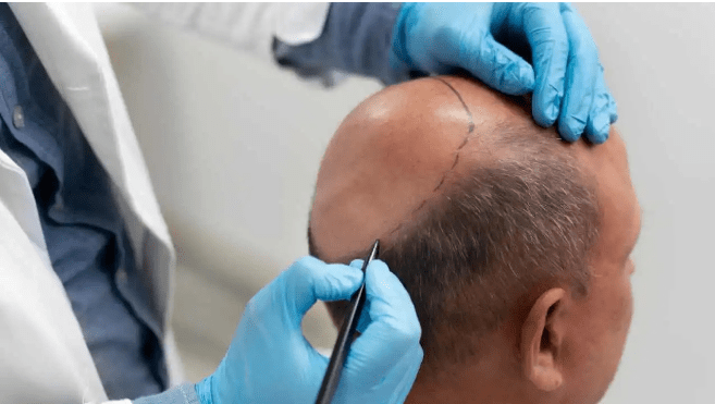 Baldness will be history! New discovery by scientists