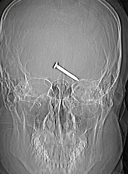 Scientific research reveals the story of shooting himself with a nail gun