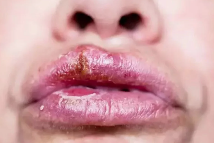 Those who develop sores around the lips and mouth in winter are in the grip of this disease! Go to the doctor immediately