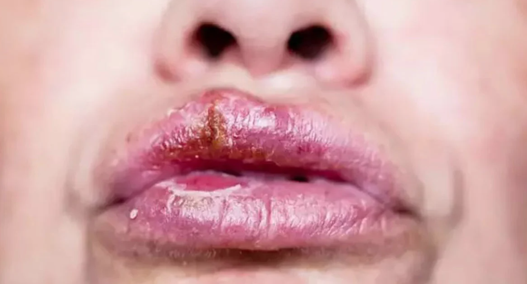 Those who develop sores around the lips and mouth in winter are in the grip of this disease! Go to the doctor immediately